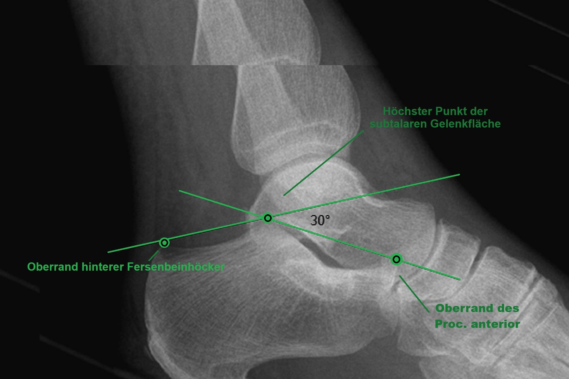boehler-winkel-normal