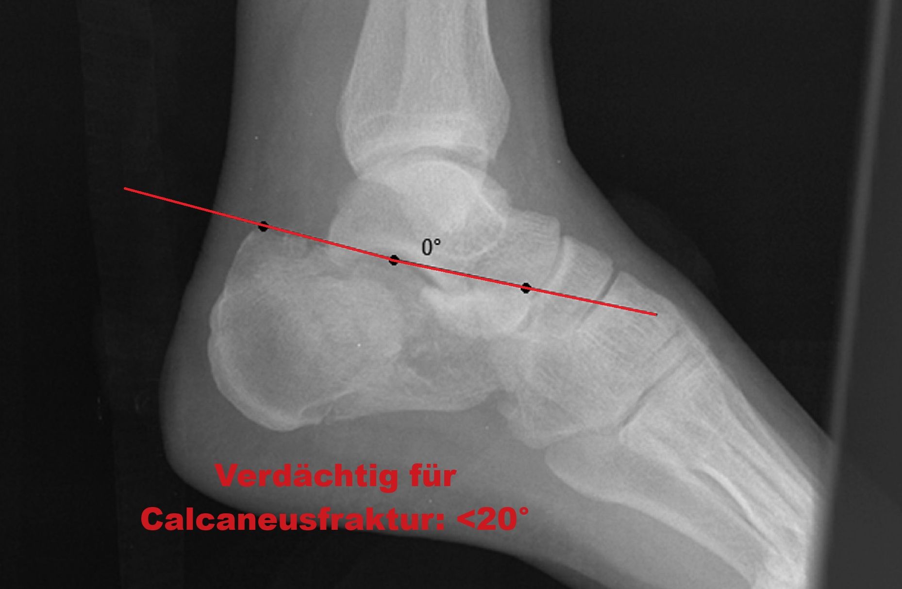 boehler-winkel-pathologisch