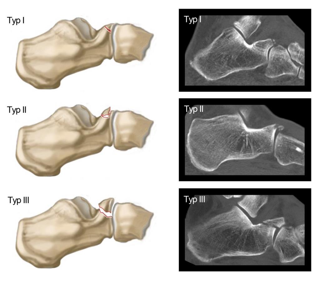 calcaneus-processus-anterius_degan-klassifikation