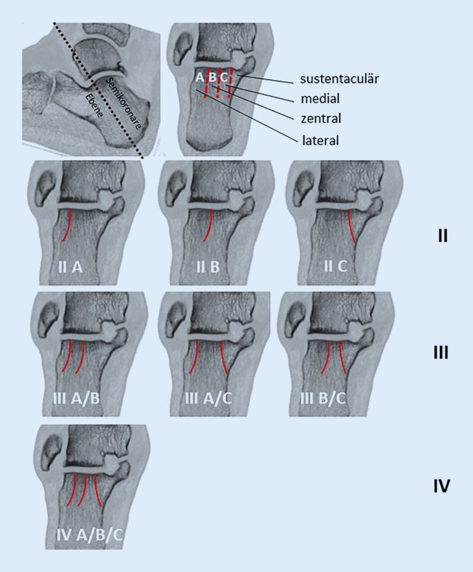 calcaneus_sanders-1