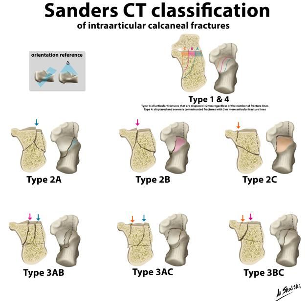 calcaneus_sanders-2