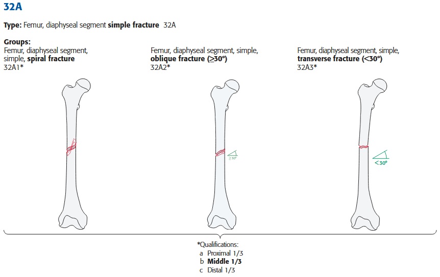 femur_diaphyse_A-einfach