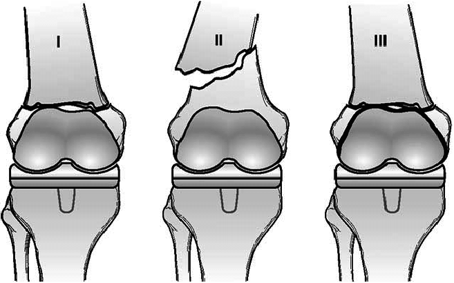 femur_distal_periprothetisch_rorabeck-2