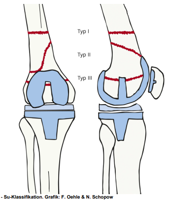 femur_distal_periprothetisch_su
