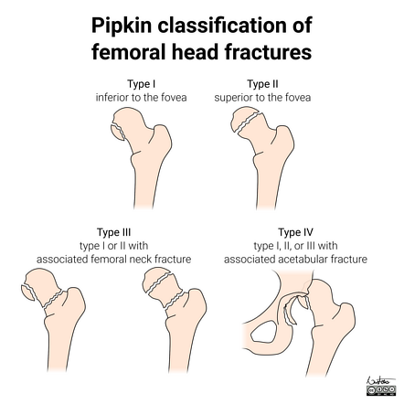 femur_kopf_pipkin