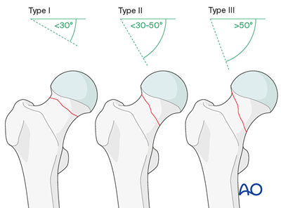 femur_schenkelhals_pauwels-1