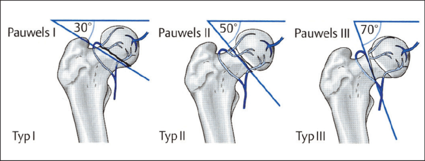 femur_schenkelhals_pauwels-2
