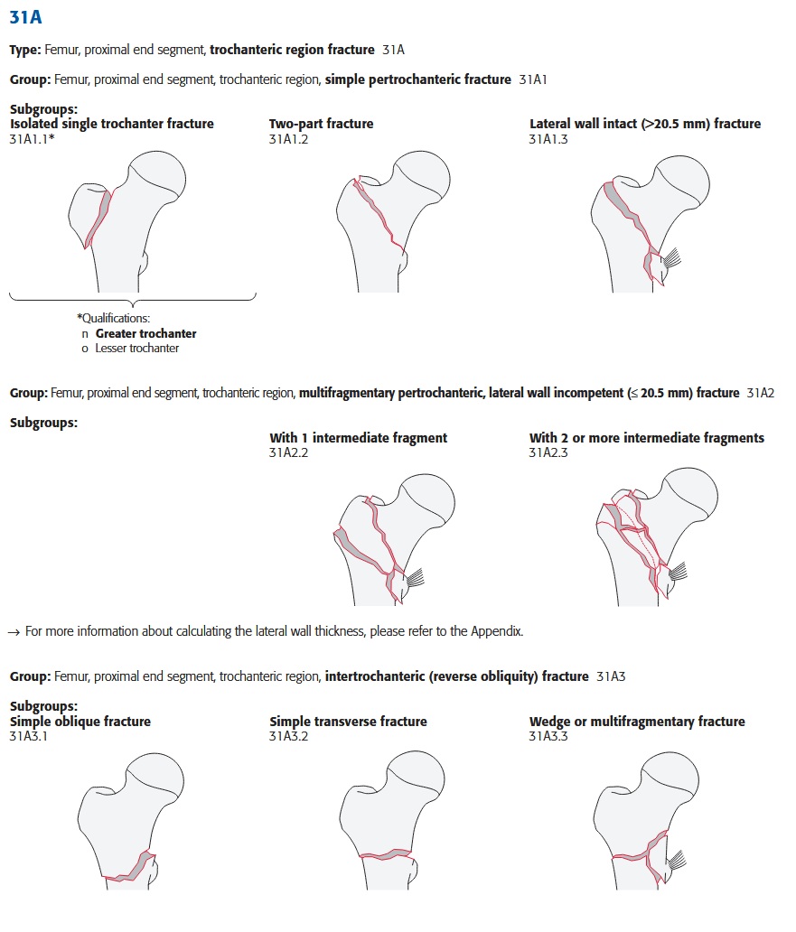 femur_trochanterregion_ao-klassifikation