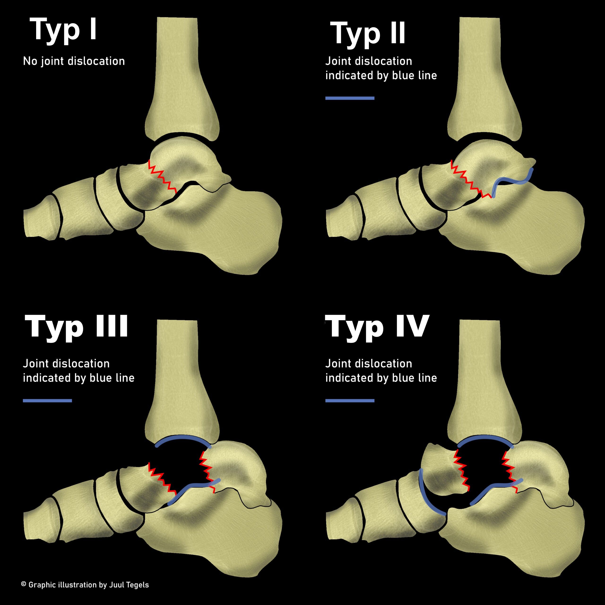talusfraktur-hals_hawkins-klassifikation