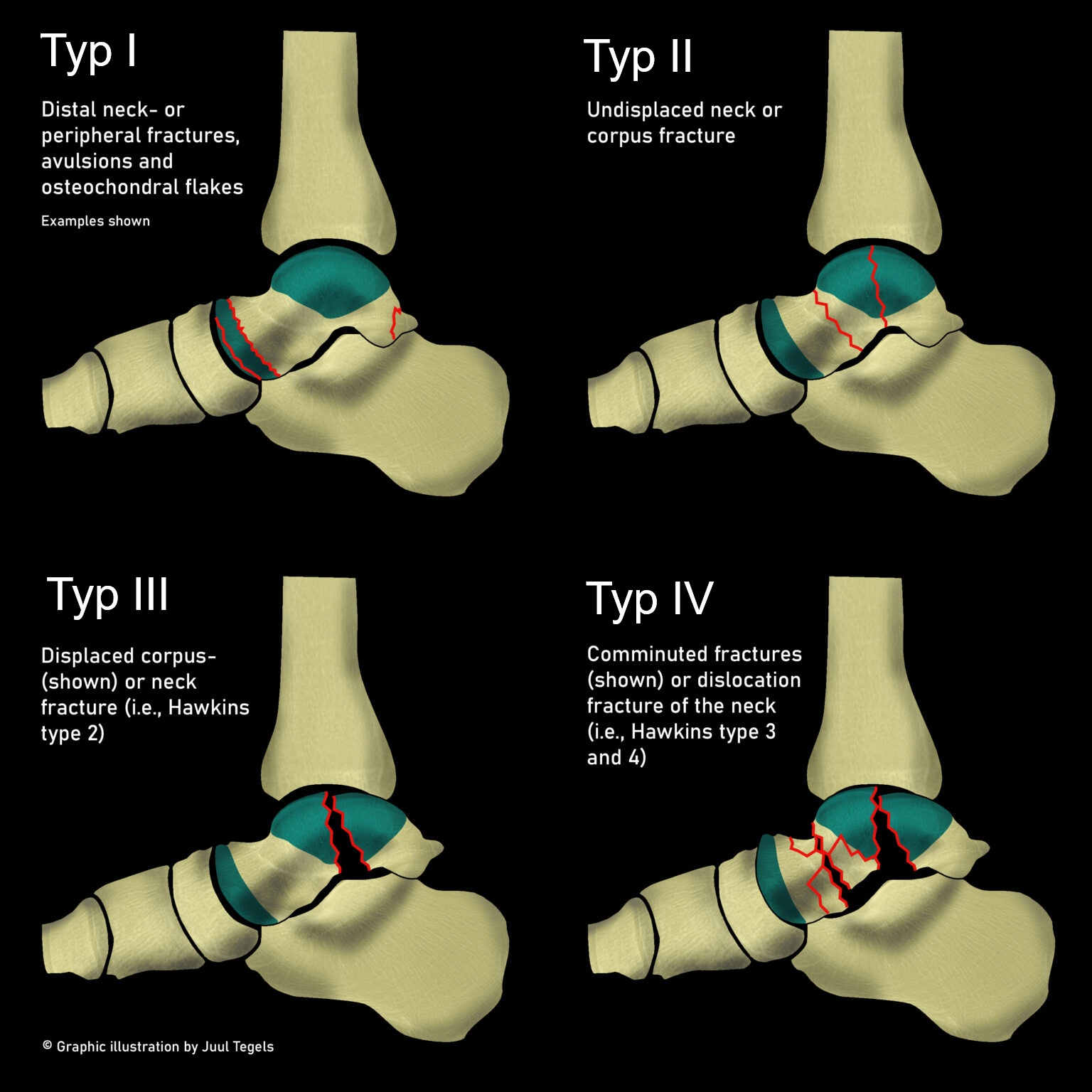 talusfraktur-marti-weber-klassifikation