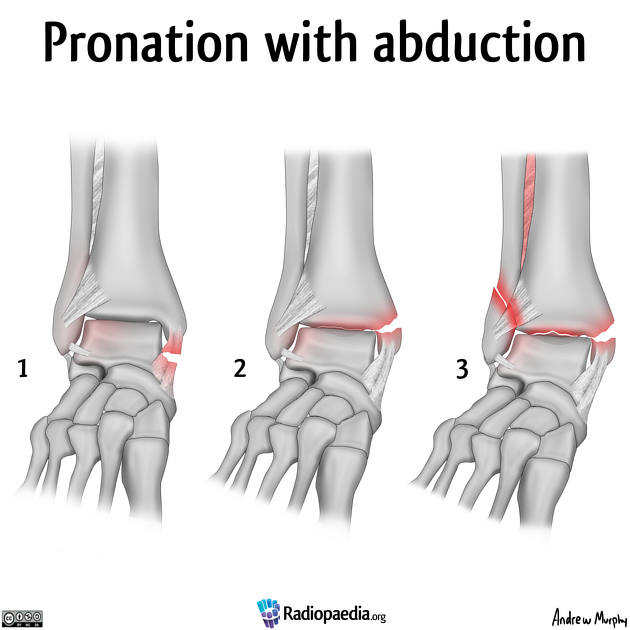 lauge-hansen_pronation-abduktion
