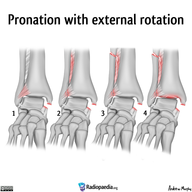 lauge-hansen_pronation-exorotation