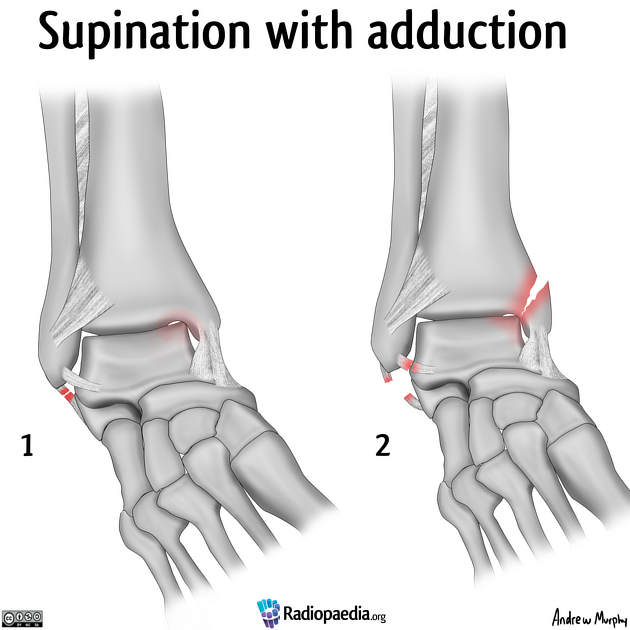 lauge-hansen_supination-adduktion