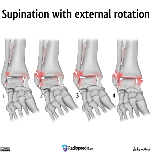 lauge-hansen_supination-exorotation