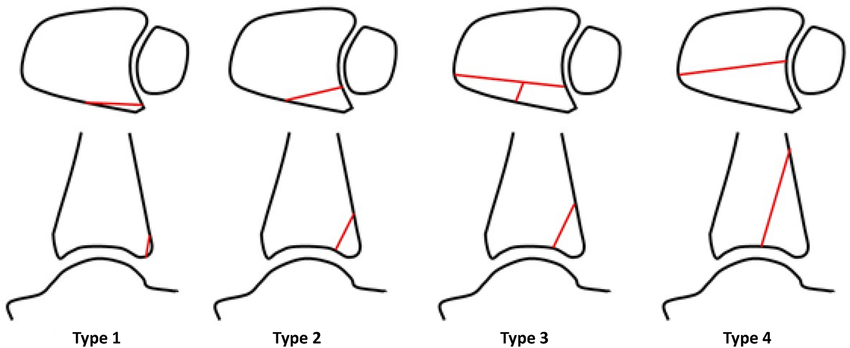 tibia-bartonicek-1