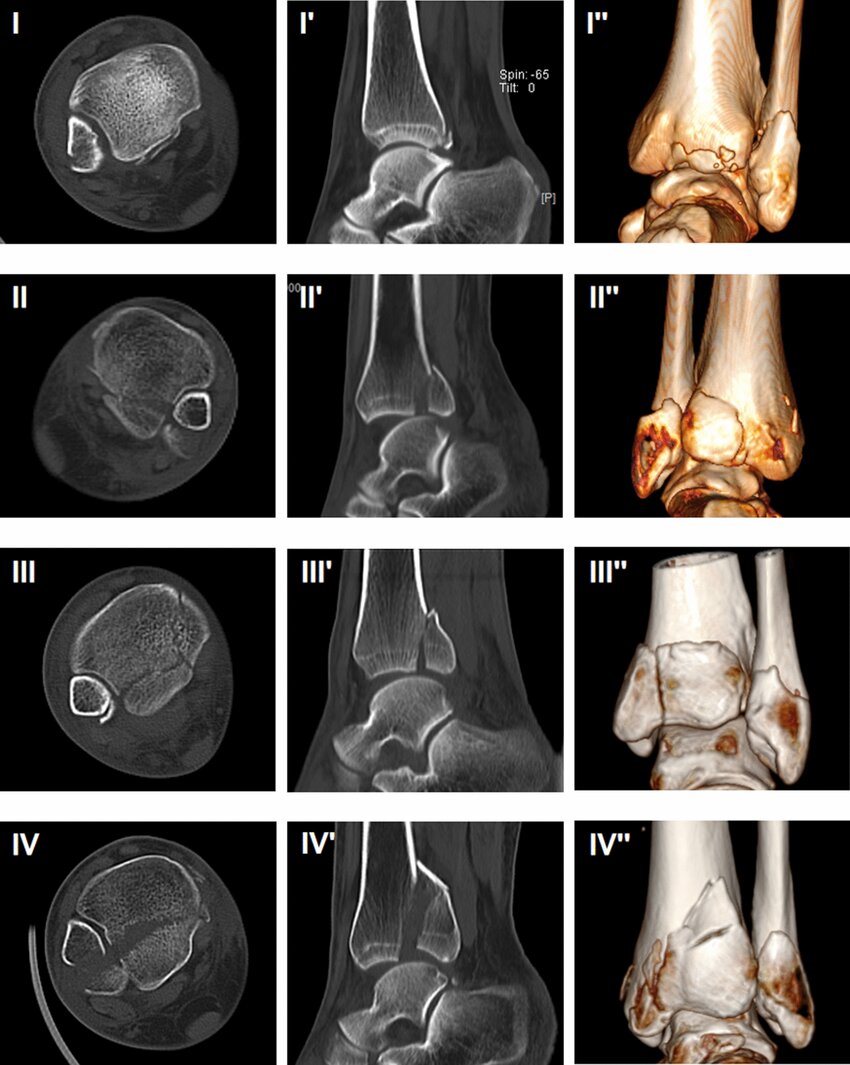 tibia-bartonicek-2