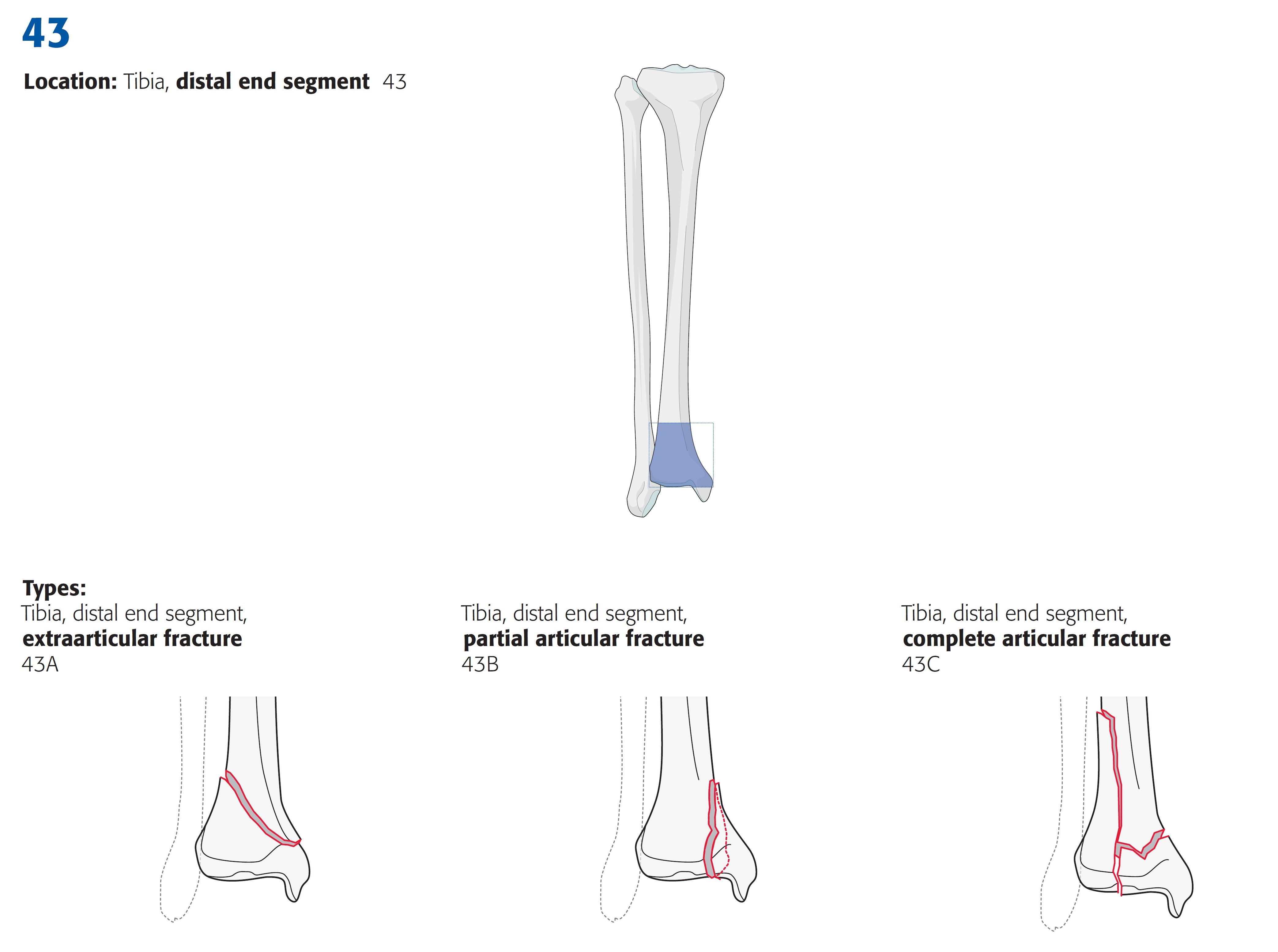 tibia_distal_ao-klassifikation-1