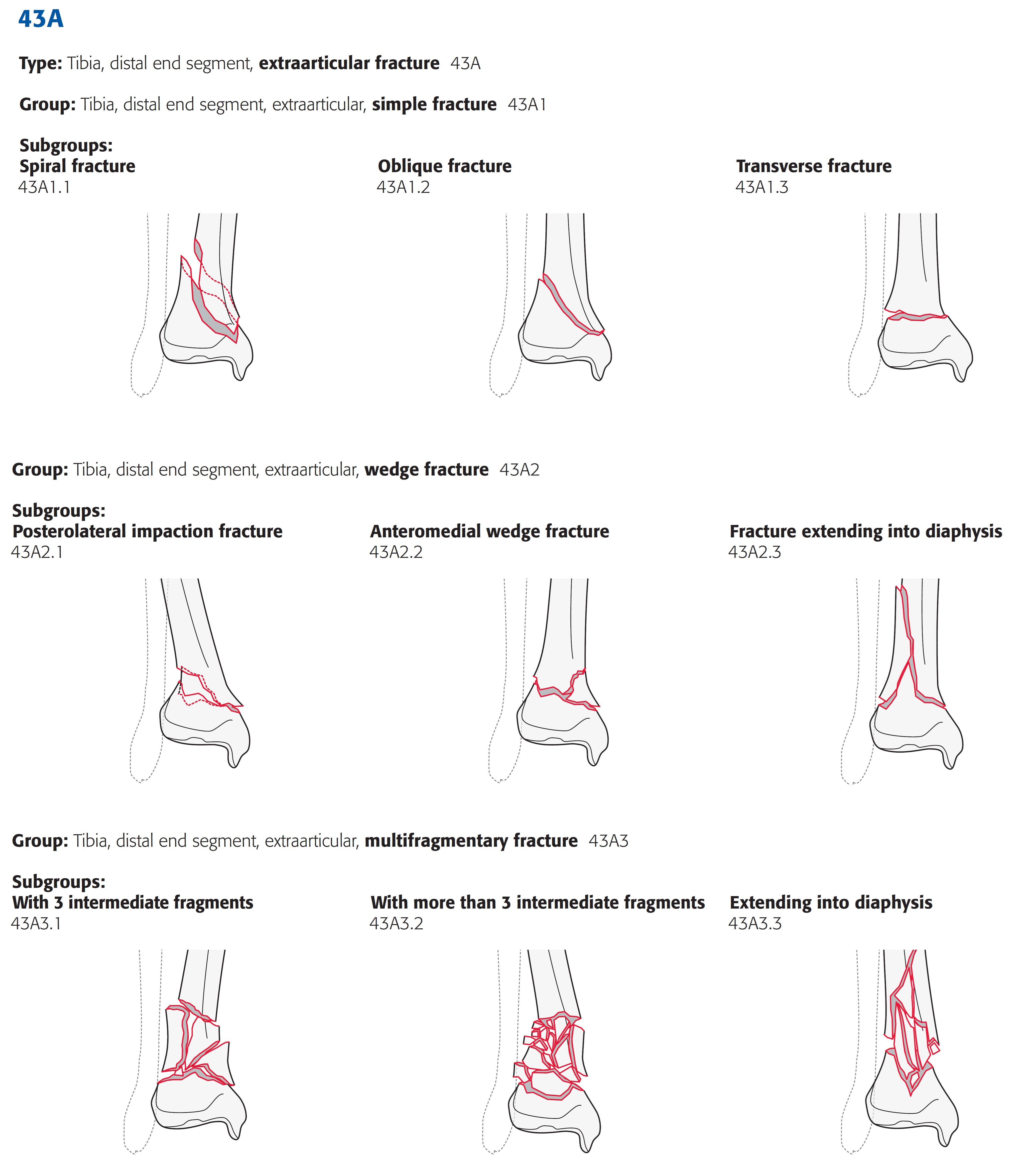 tibia_distal_ao-klassifikation-2
