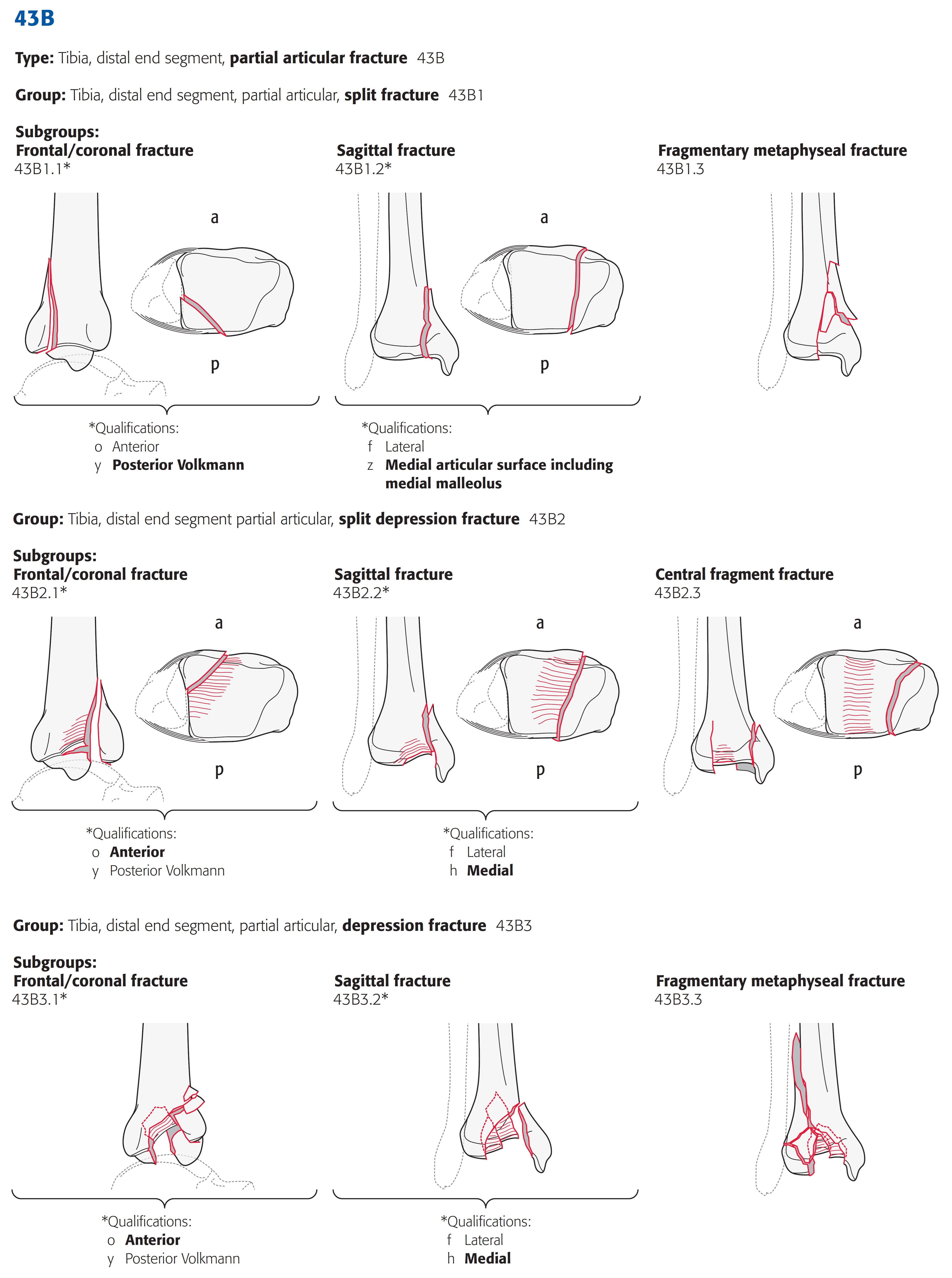 tibia_distal_ao-klassifikation-3