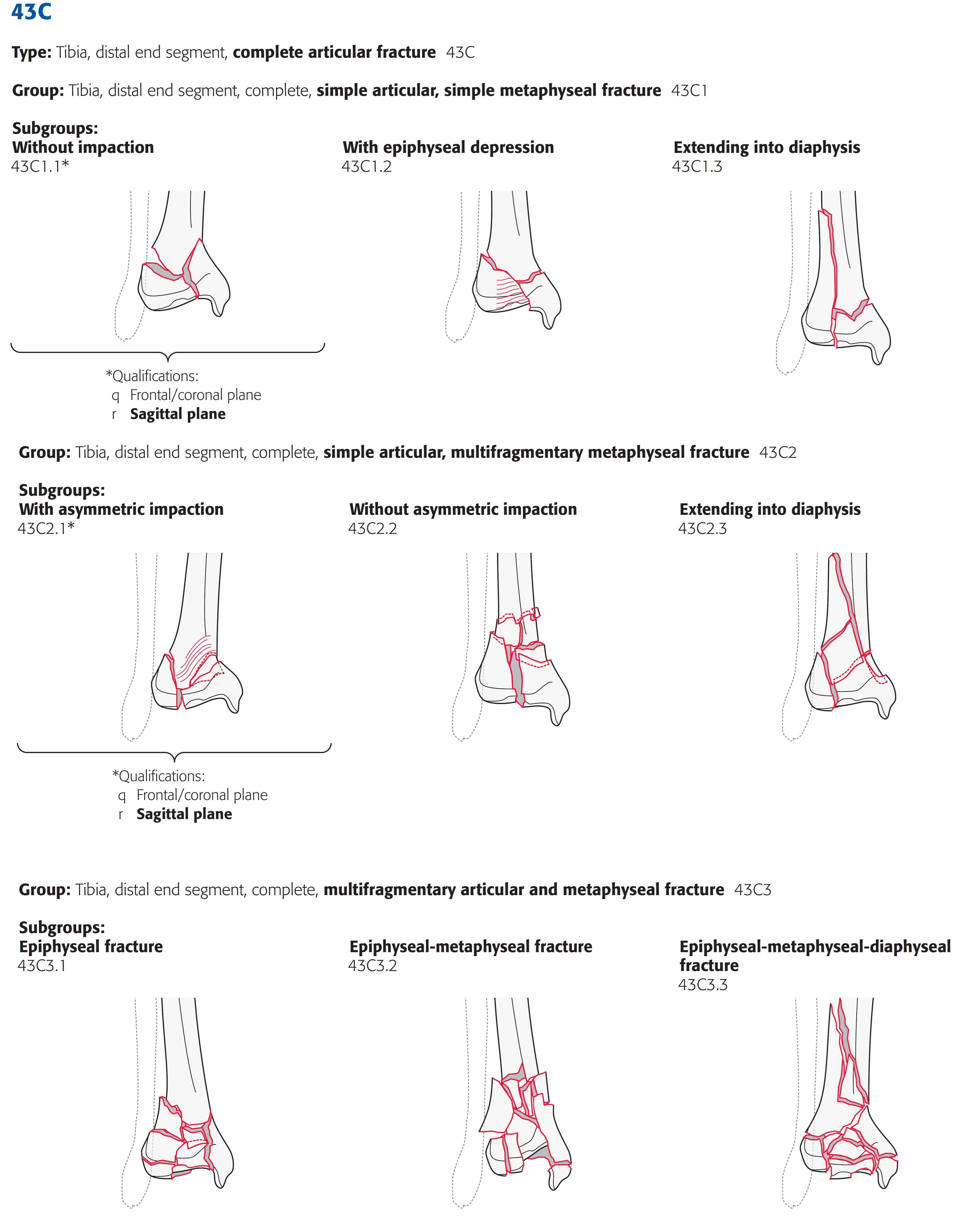 tibia_distal_ao-klassifikation-4