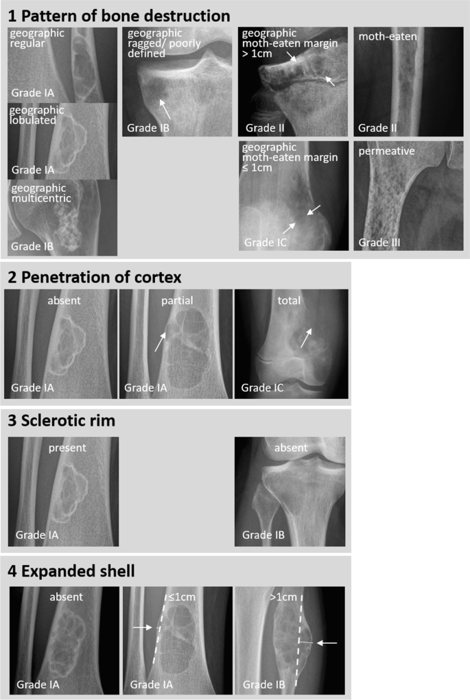 knochenveränderungen_osteolyse_lodwick-2