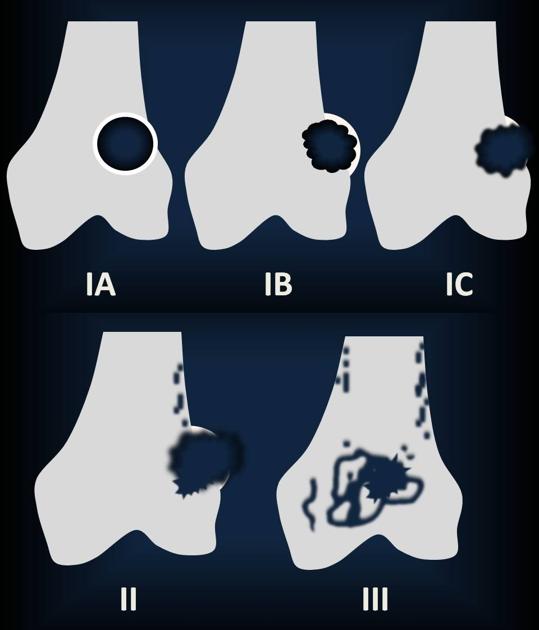 knochenveränderungen_osteolyse_lodwick-3