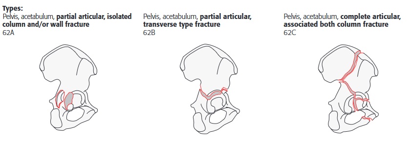 acetabulum_ao_uebersicht