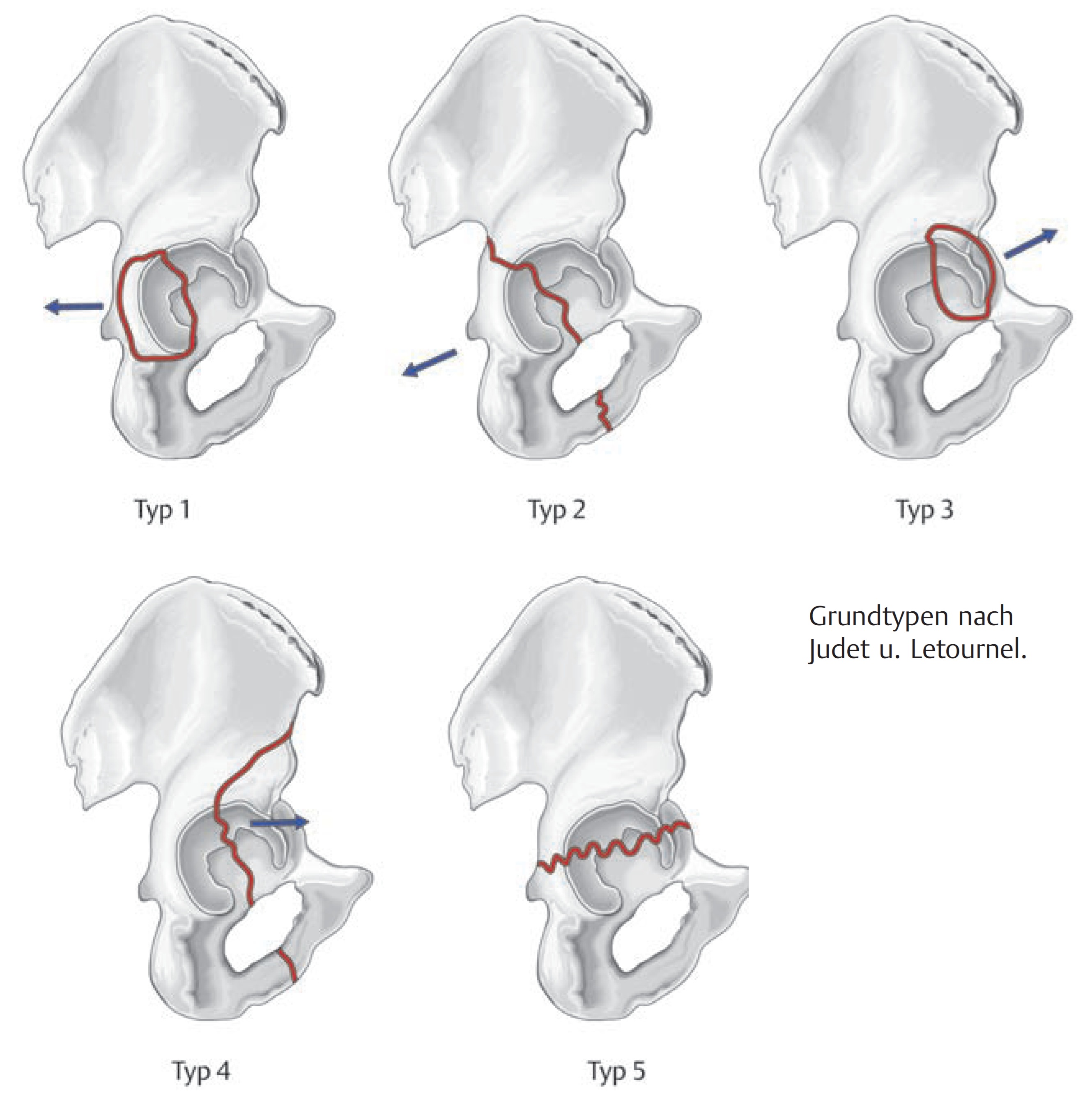 becken_acetabulum_letournel-judet-2