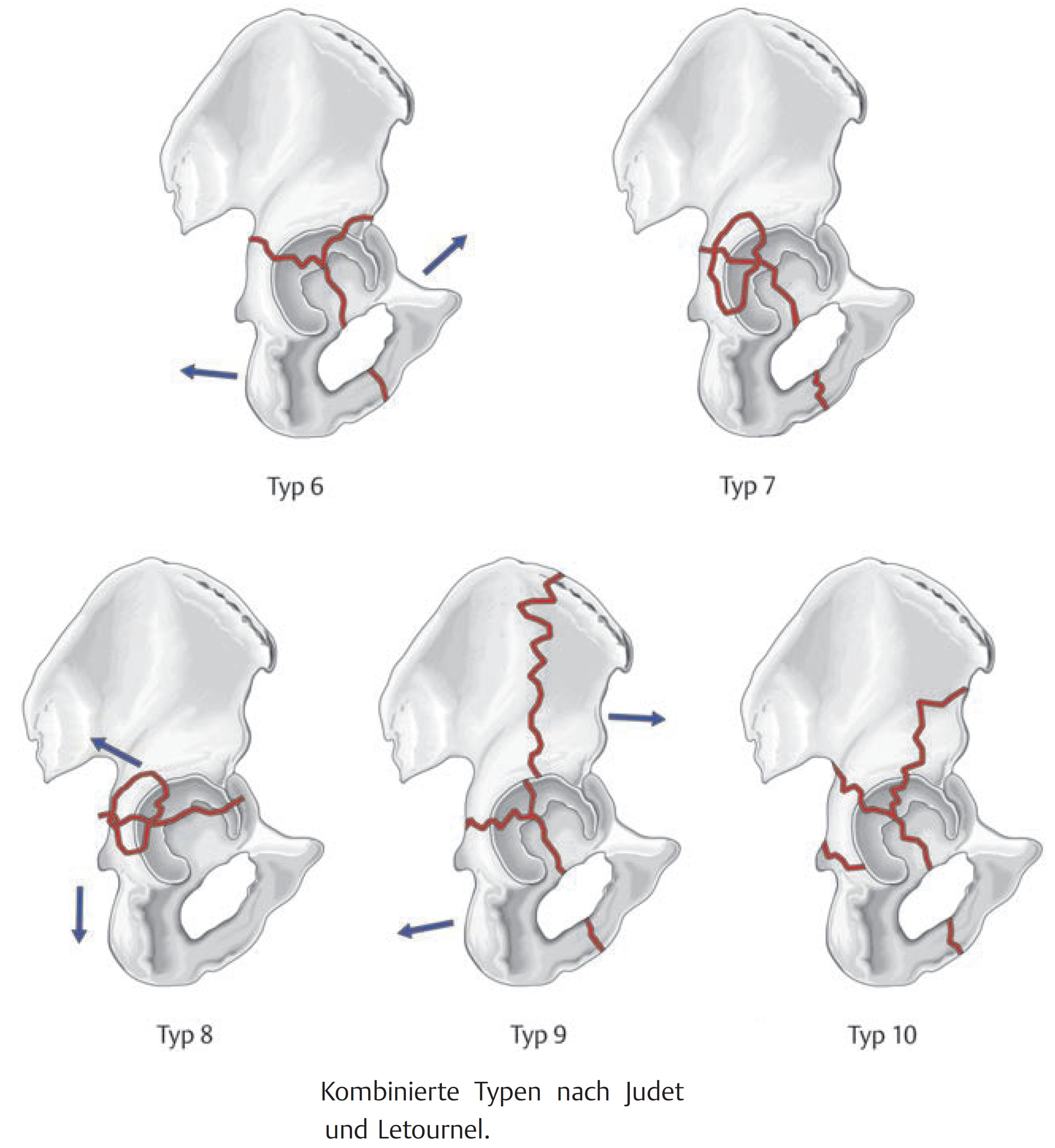 becken_acetabulum_letournel-judet-3