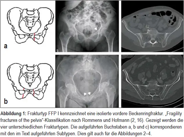 beckenring_ffp-2a