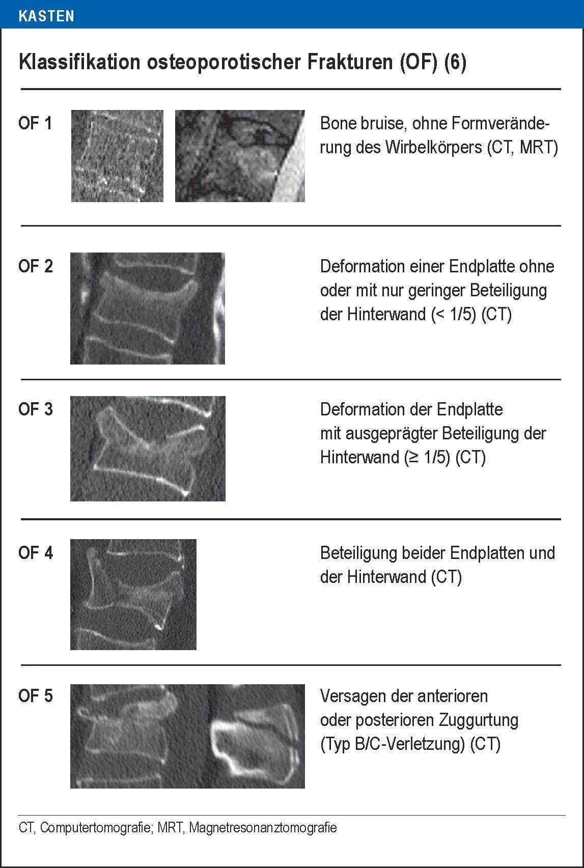 of-klassifikation_osteoporotisch-wirbelsäule