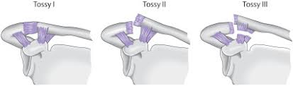 ac-gelenk_tossy