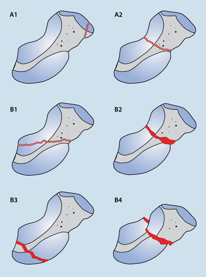 scaphoid_krimmer-herbert-1