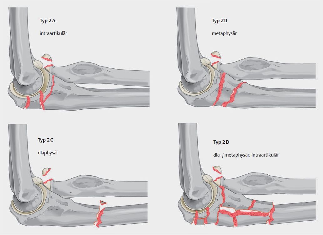 jupiter-subklassifikation-posteriore-monteggia-fraktur