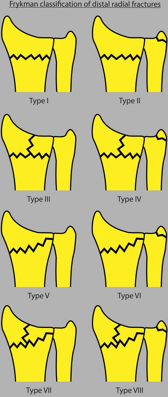 radius_distal_frykman