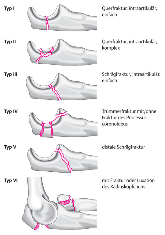 ulna_olecranon_schatzker