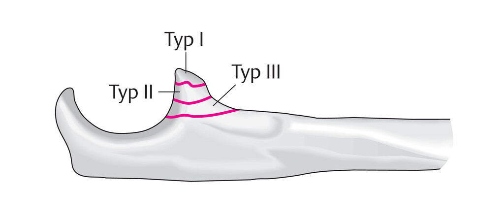 ulna_proc-coronoideus_regan-morrey